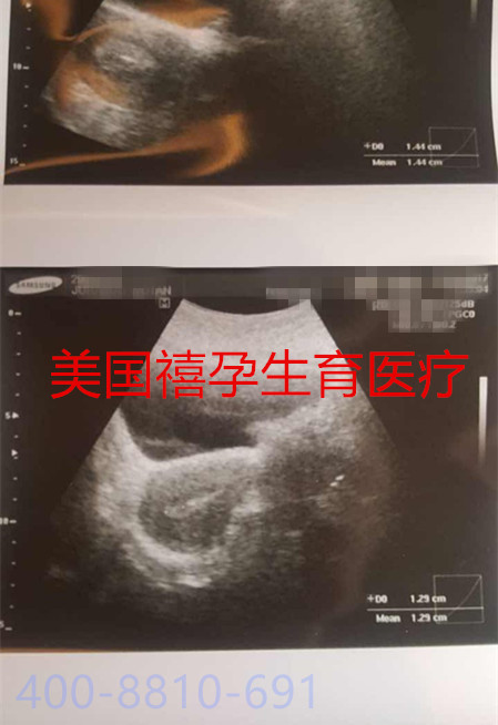 禧孕HRC美国试管婴儿的大龄女性-赴美试管前该做什么？