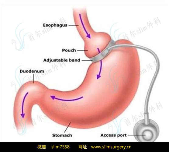 【韩国slim朴润赞科普减肥手术】胃束带手术VS胃袖状切除术优缺点