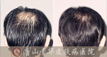 唐山专家讲述溢性脱发的原因有哪些