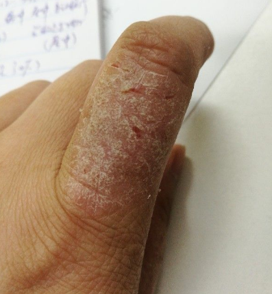 手湿疹怎么治疗，这种方法解决你的烦恼