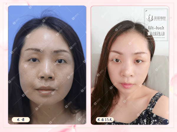 lift-lock童颜线雕.png lift-lock童颜线雕.png