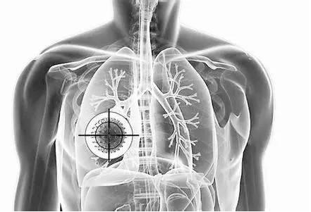 肺癌帮： 一线治疗肺癌，美国FDA又有新动向