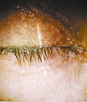 深圳希玛林顺潮眼科医院：日常生活需细心，小心惹祸