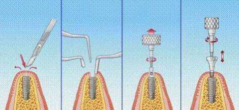南通美奥口腔：种植牙要想“长寿”，还需看保障