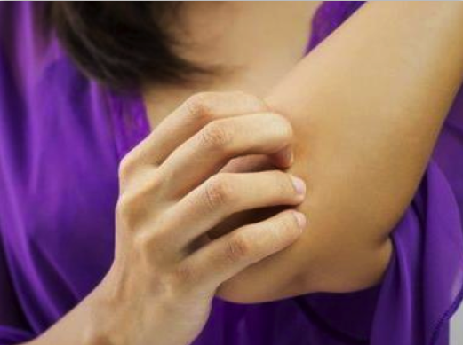 湿疹皲裂怎么办？这个东西用的越早越好