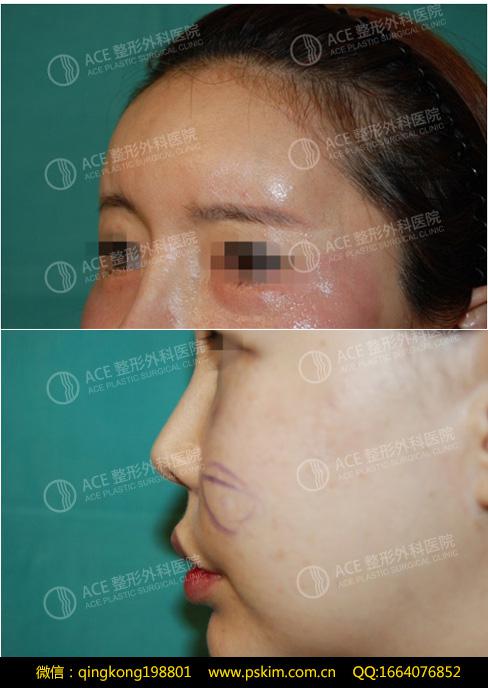 脂肪填充后遗症克星韩国-ACE“Lipolis”针剂注射修复