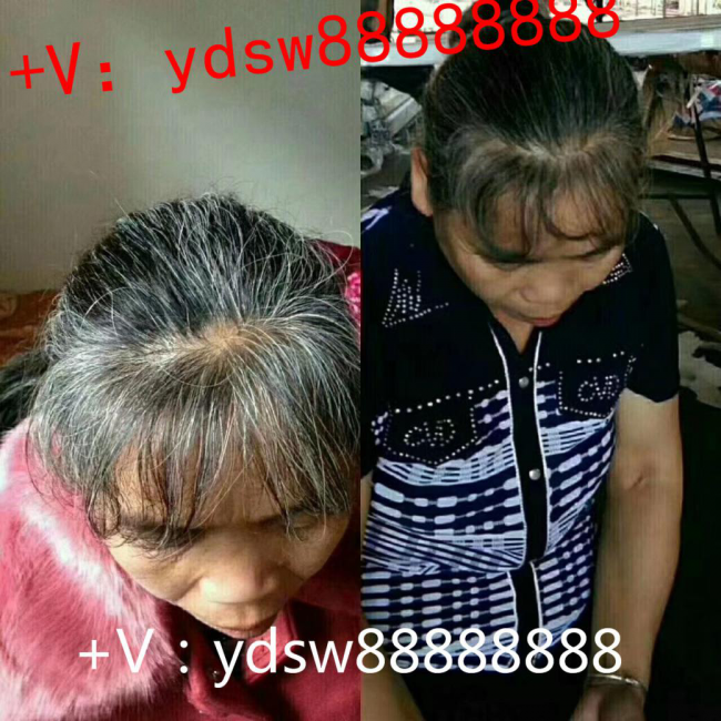 易丹医坊:洗头方式不对会导致大把的脱发！