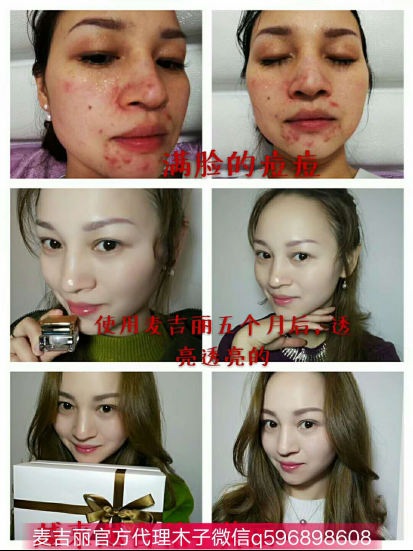 麦吉丽素颜三部曲能解决痘痘肌肤吗？适合什么年龄阶段使用