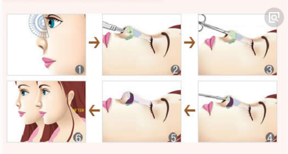 青岛伊美尔MISKO plus鼻综合：带您领略非手术隆鼻风采