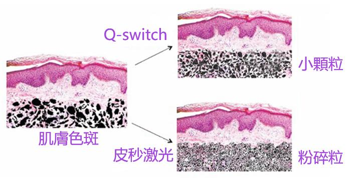 香港DR REBORN为你揭秘皮秒激光 