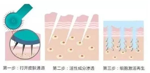 天津伊美尔王牌新品季，类人胶原蛋白微针滚出青春美肌